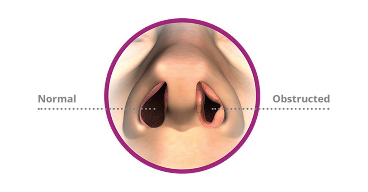 Normal nasal passage vs obstructed nasal passage