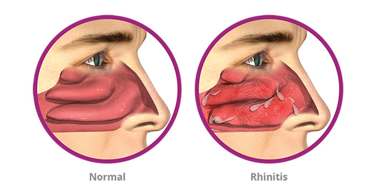RhinAer normal vs. rhinitis graphic