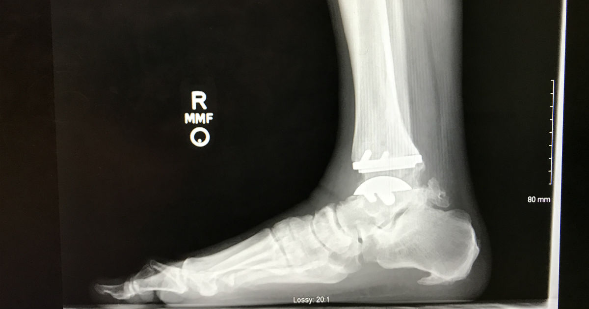 Matt Stevenson x-ray of ankle and foot
