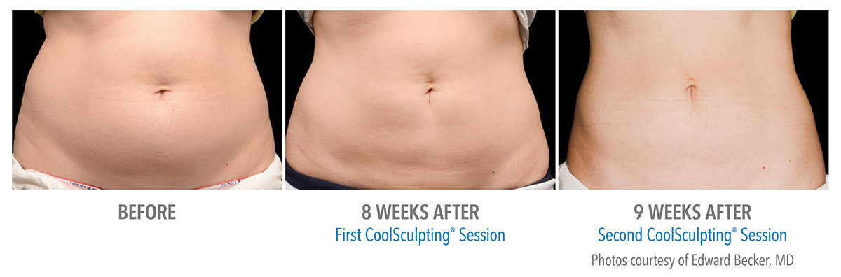 Cool Sculpting Results