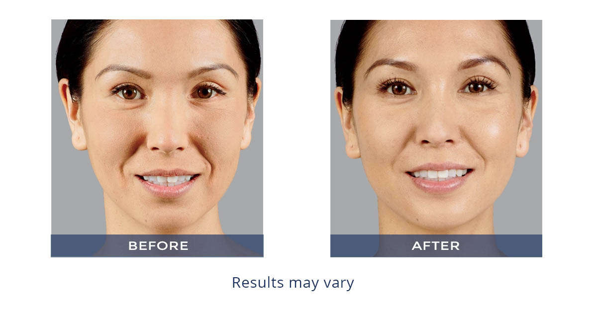 Juvéderm Voluma XC before and after