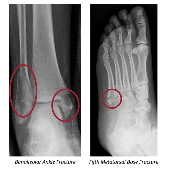 X-Rays of a bimalleolar ankle fracture and a fifth metatarsal base fracture.