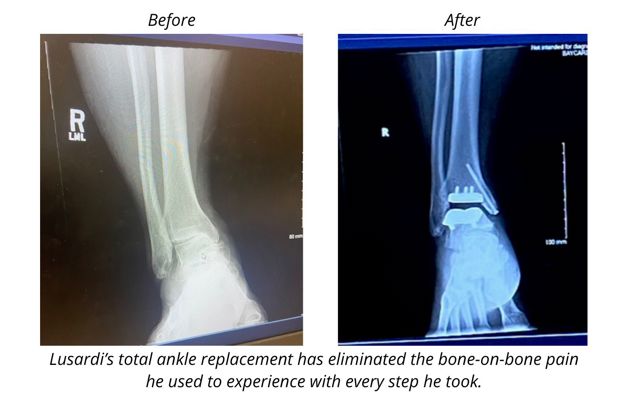 X-Rays showing a patient's ankle before and after total ankle replacement.